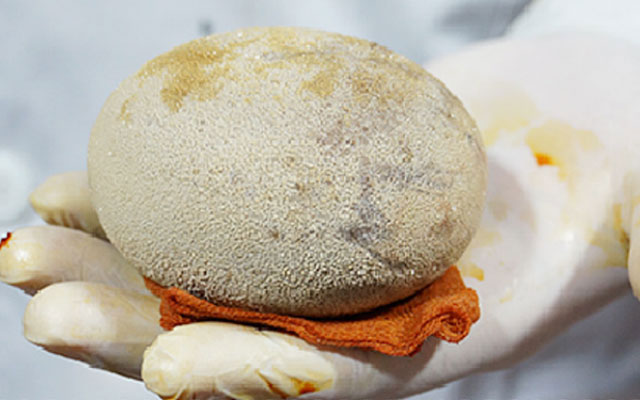 输尿管结石反复发作如何治疗?